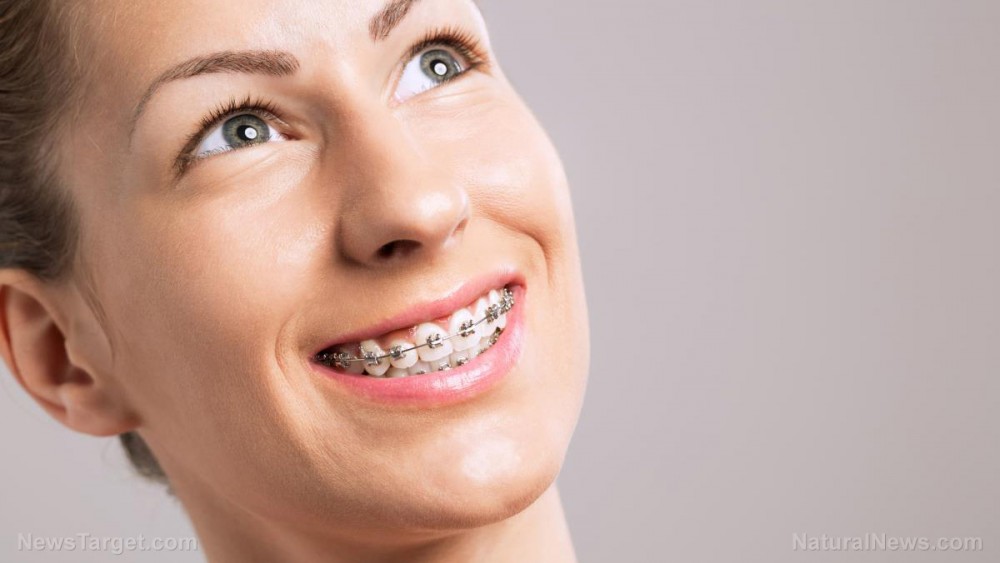 The risk of braces: Study finds dental correction doesn’t always yield the expected confidence boost … Are the benefits worth the health risks?